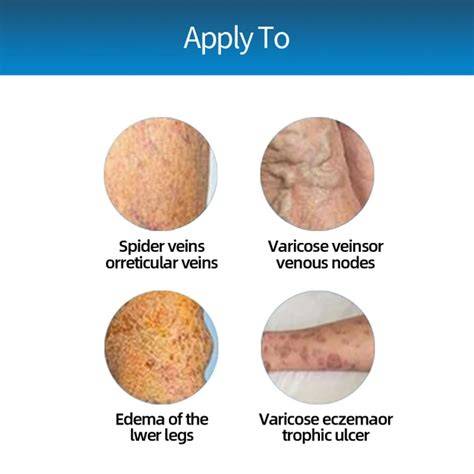 Varises Vulva