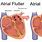 What Is Atrial Flutter