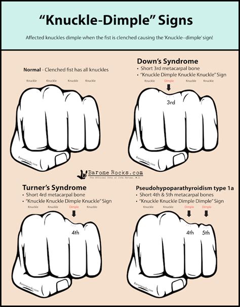 What are knuckle dimples