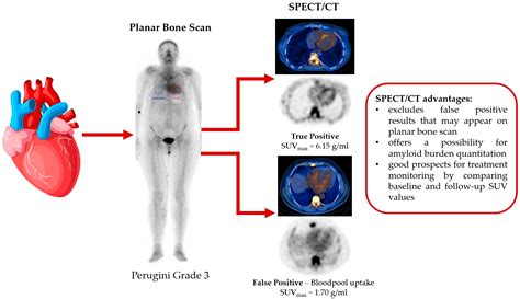 What are the disadvantages of a Spect scan