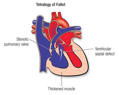 What are the four components of tetralogy of Fallot