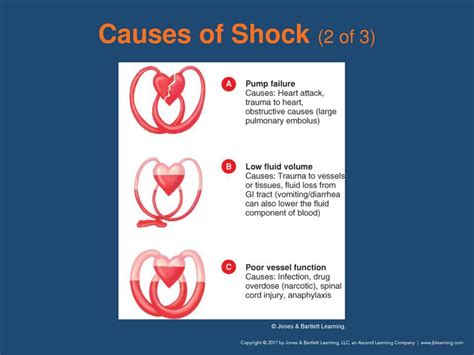What are the three basic causes of shock