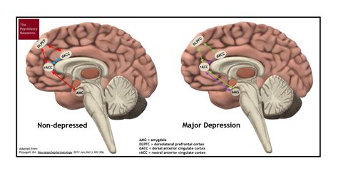 What brain activity causes depression