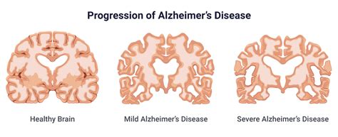 What causes Alzheimer s to progress quickly