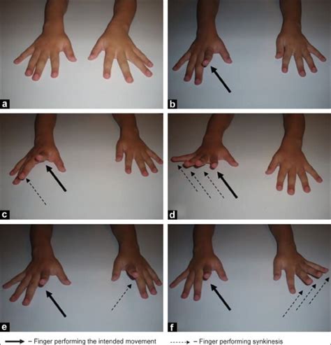 What causes mirror movement disorder