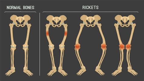 What causes rickets