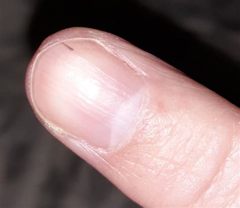 What causes thin black lines in fingernails