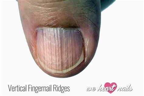 What causes vertical ridges in fingernails