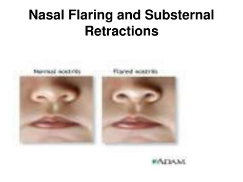 What does Substernal mean