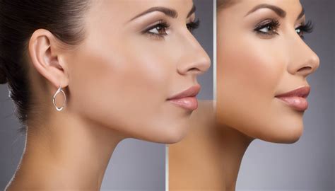 What does chin augmentation do