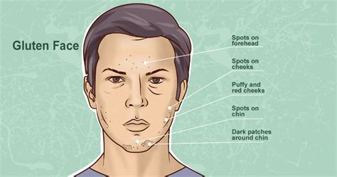 What does it mean if your chin is breaking out