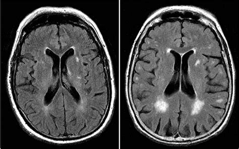 What does it mean when you have white matter on a brain MRI