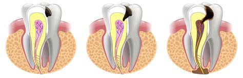 What happens if a cavity is too deep