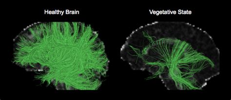 What happens when you are in a vegetative state
