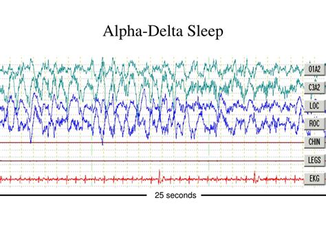 What is Alpha Delta sleep