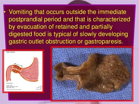 What is Feculent emesis
