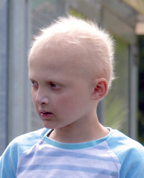 What is Hypohidrotic ectodermal dysplasia