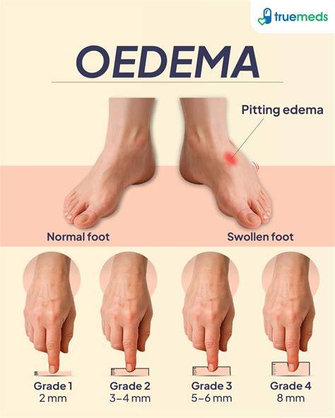 What is Oedema