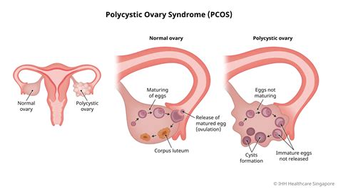 What is PCOS