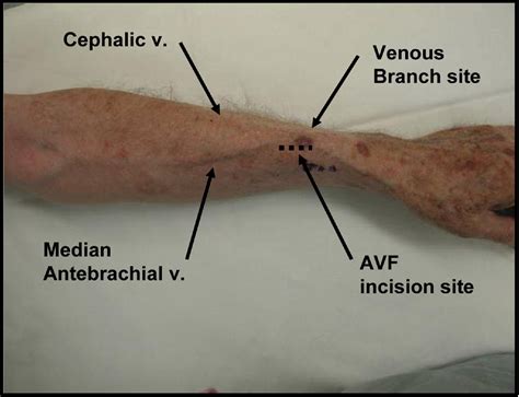 What is a Radiocephalic fistula