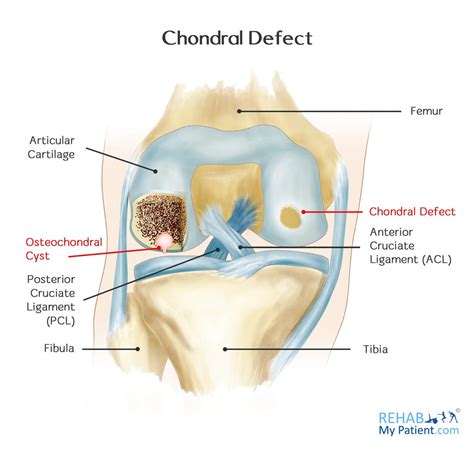 What is a chondral defect