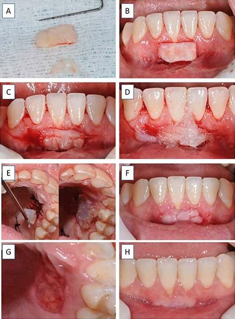 What is a connective tissue graft