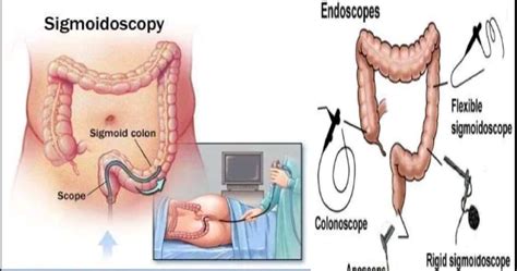What is a rigid sigmoidoscopy