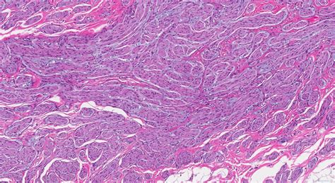 What is a traumatic neuroma