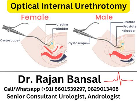 What is an internal Urethrotomy
