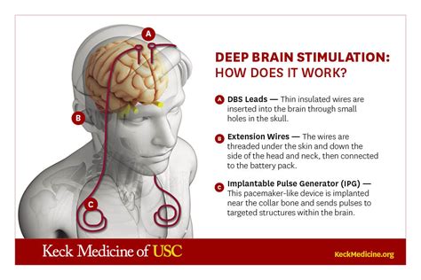 What is brain stimulation used for