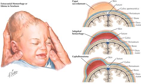 What is caput Succedaneum