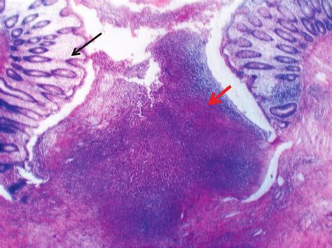 What is focal perforation