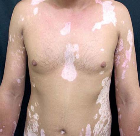 What is generalized vitiligo