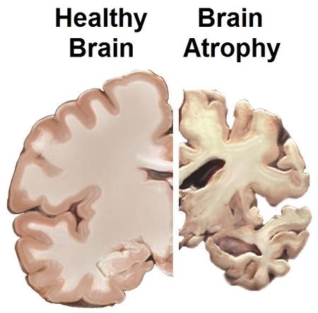 What is global brain atrophy
