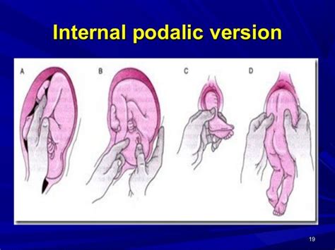 What is internal Podalic version