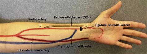 What is ligation of AV fistula