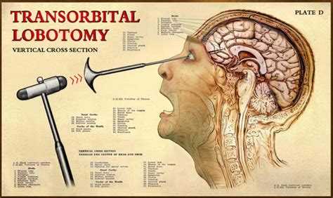 What is lobotomy in English