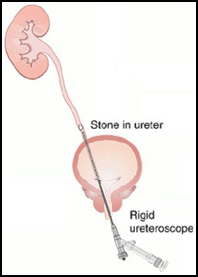 What is rigid ureteroscopy