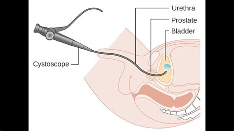 What is the CPT code for bladder biopsy