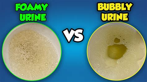 What is the difference between bubbles and foam in urine