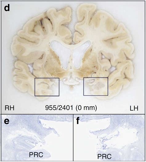 What is the main memory deficit shown by HM