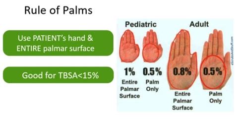 What is the rule of palms in burn