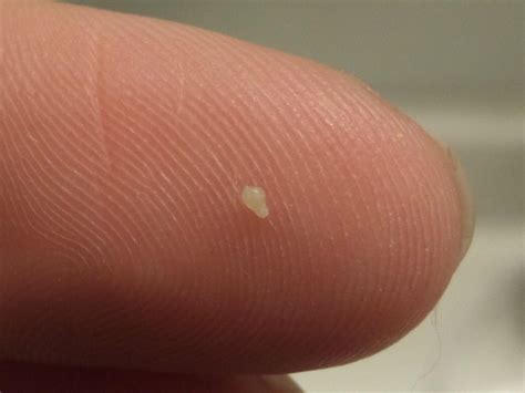 What is the seed that comes out of a pimple