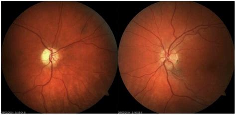 What is traumatic optic neuropathy