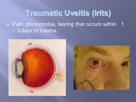 What is traumatic uveitis