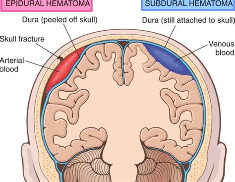 Why is there a lucid interval in epidural hematoma