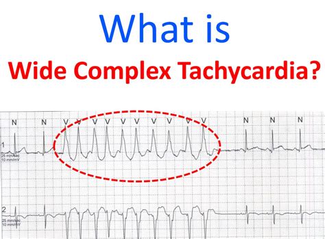 Wide Complex Tachycardia … 