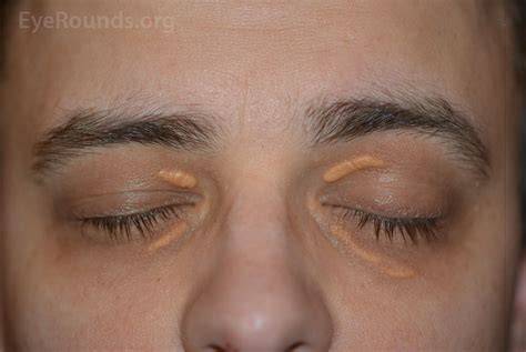 Xanthelasma Palpebrae