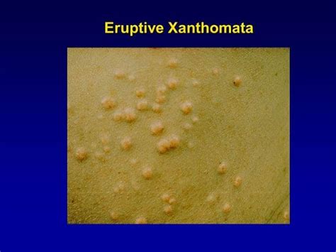 Xanthoma Eruptif