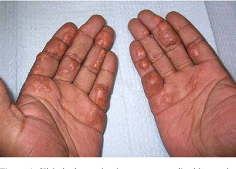 Xanthoma Palmar
